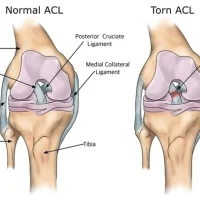 ACL-ligament-dr.barik_
