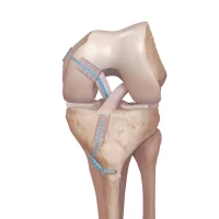 Acl-Reconstruction-with-internal-brace-technique