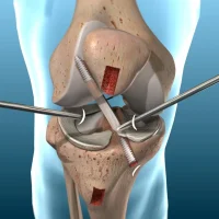acl-repair-dr.barik_